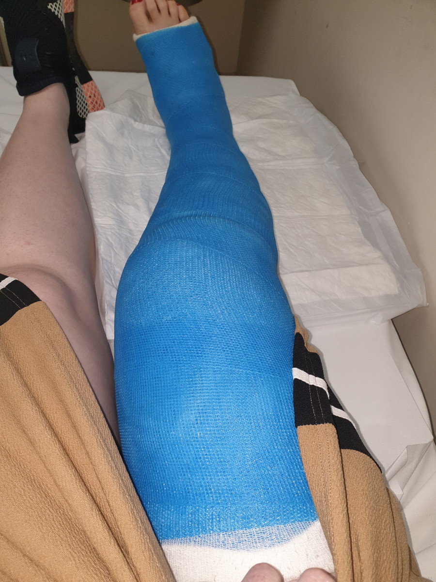 fractured-leg-recovery.jpg