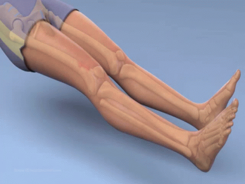 leg-surgery-rotationplasty.gif