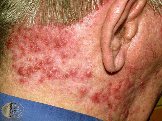 Folliculitis-red-bumps-back-neck.jpg